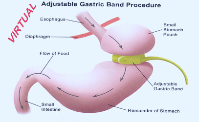 Virtual Gastric Band Therapy in St. George, UT | Synergy Massage & Personal  Fitness
